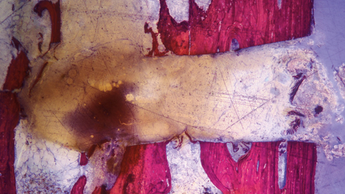 photo histologique de coupe d'os avec la fraise à os 